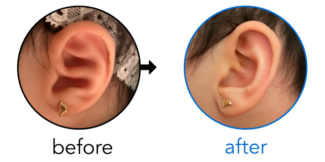 Before-and-after EarBuddies Conchal Crus result; started at 1–3 months – Jeffry, Judy & their Daughter Alaia Lucia