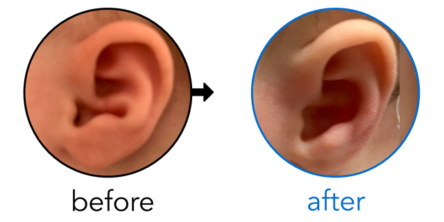 Before-and-after EarBuddies Conchal Crus result; started at 1–3 months – Talia & her daughter Millie