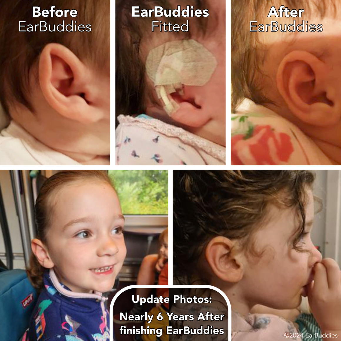 Babys Ears starting to Stick Out or Fold Over? | EarBuddies™