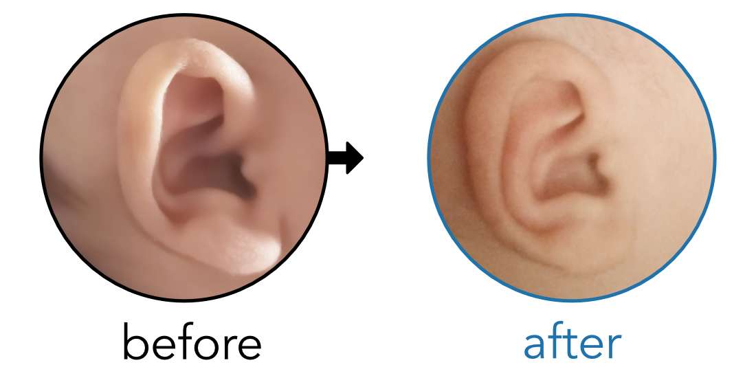 Before-and-after EarBuddies Stick-Out Ears result; started at 1–3 months – Nada & her son