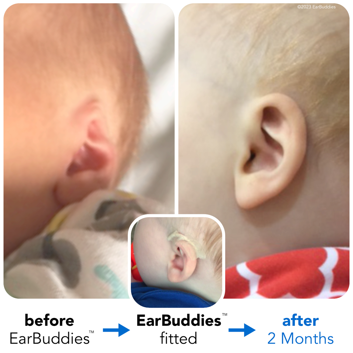 Babys Ears starting to Stick Out or Fold Over? EarBuddies™