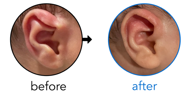 Before-and-after EarBuddies Lop Ear result; started at 1–3 months – Sara & her son