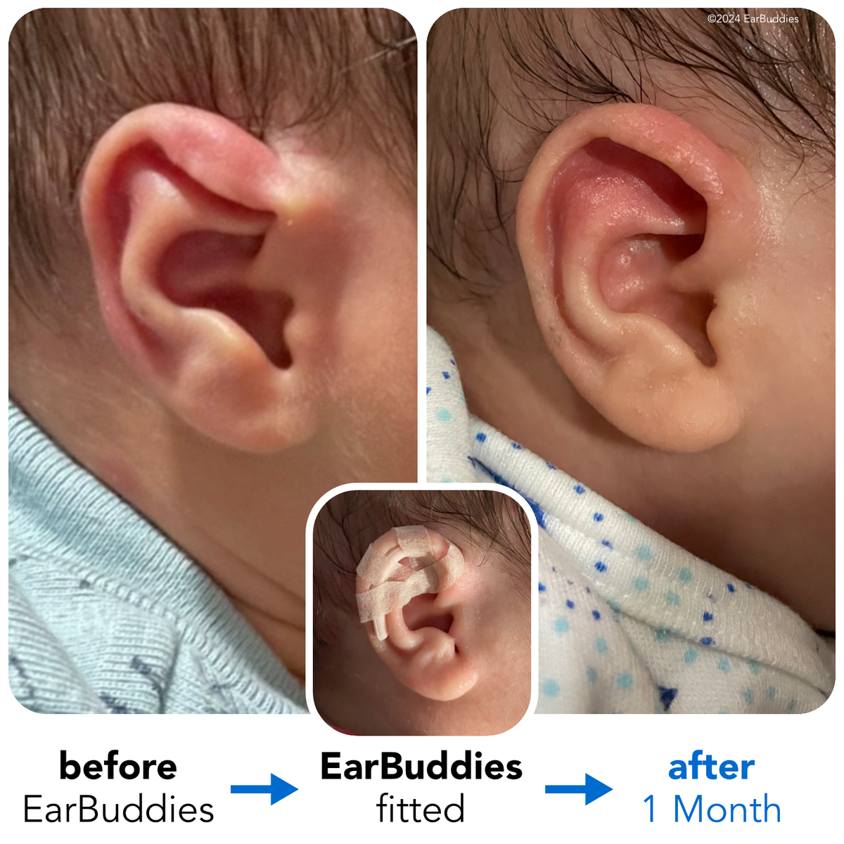 EarBuddies | Permanent Solution to Stick-Out Ears & Ear Deformities