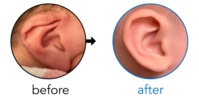 Before-and-after EarBuddies Lop Ear result; started within the first month – Andrea & her son