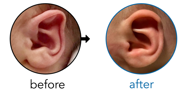 Before-and-after EarBuddies Stahl's Bar result; started within the first month – Laura & her daughter